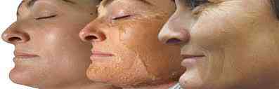 Skin peel kit - verwijdert huidlabels, ouderdomsvlekken, witte vlekken, striae