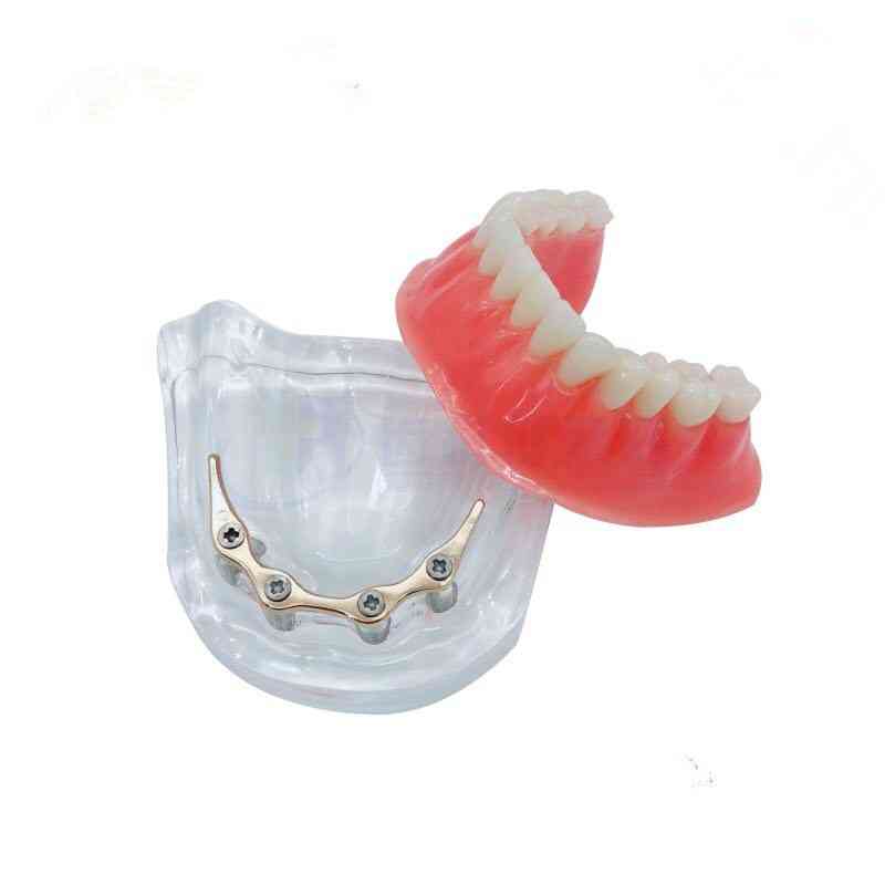 Model de dinți de supradentură cu predare și cercetare cu bare de aur