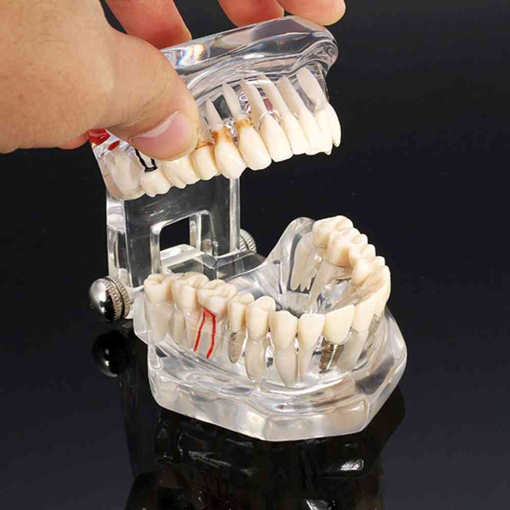 1 st vuxen tandhartsrenoveringsmodell för tänderundersökning, tandläkarverktyg tandläkemedels laboratorium transparent modell