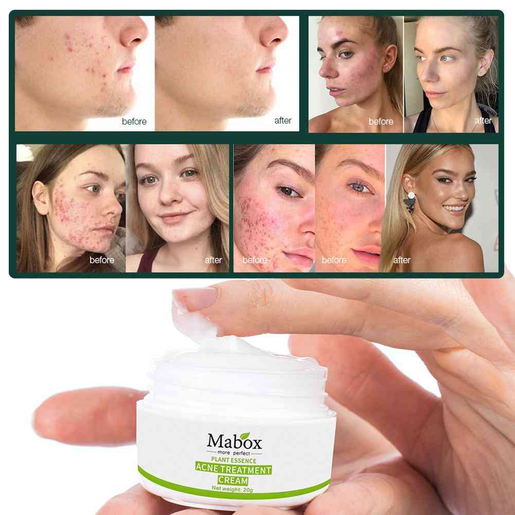 Crema para eliminar marcas de acné - crema hidratante para reducir el acné para el cuidado facial para hombres y mujeres -