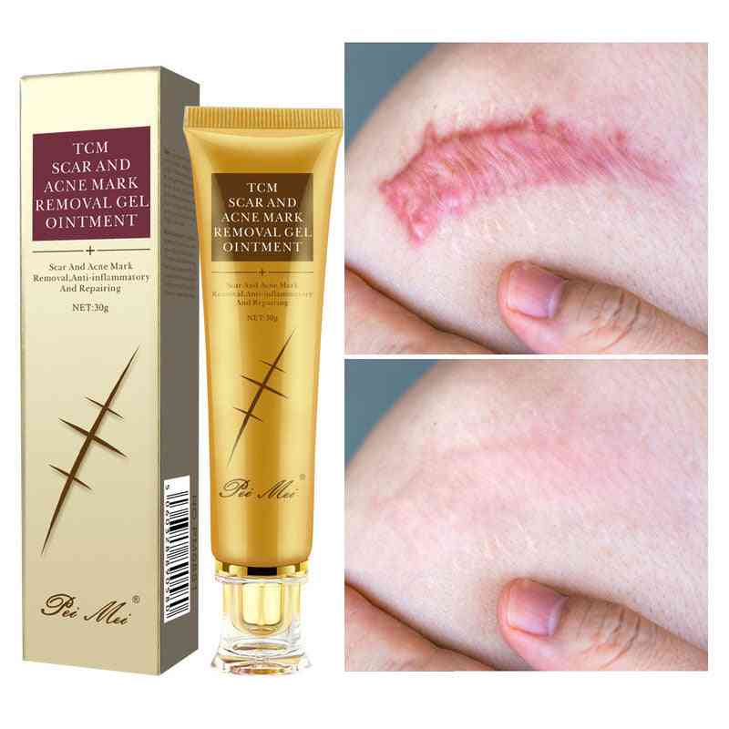 Acne Scar Removal Gel Face Pimples Stretch Marks Cream
