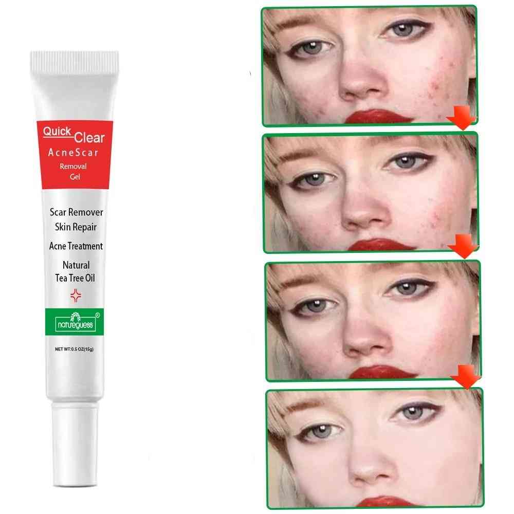 Gesichtscreme zur Behandlung von Akne