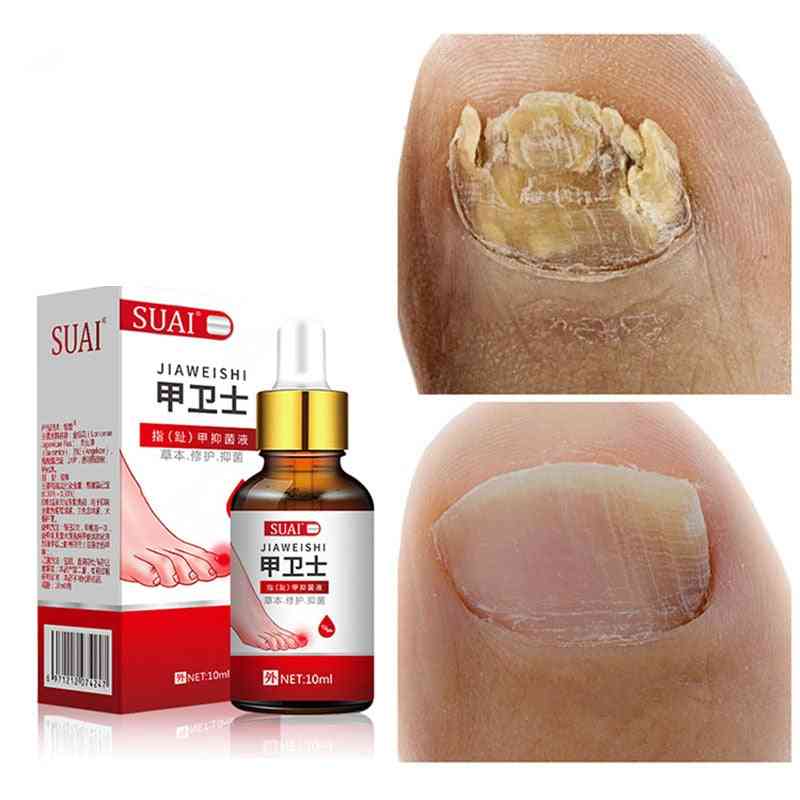 Foot Whitening Toe Nail Fungus Removal Gel