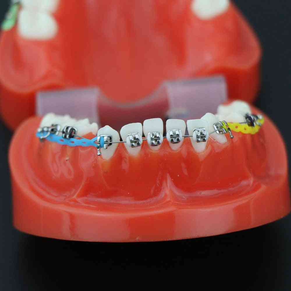 Dental Orthodontic Treatment Malocclusion Model With Ceramic Brackets
