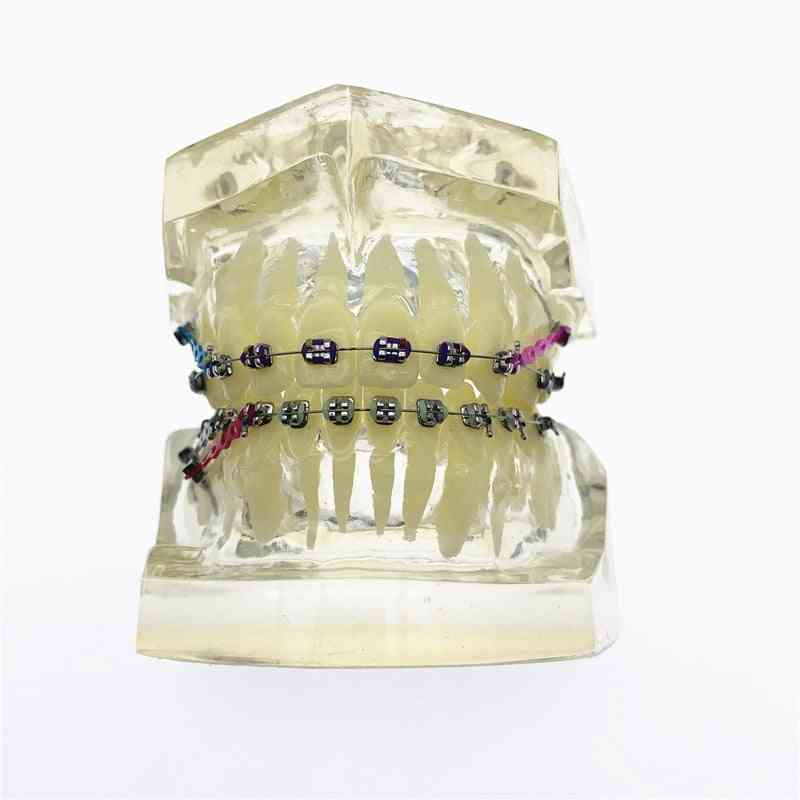 Dental Orthodontic Teeth Malocclusion Orthodontic Model With Brackets
